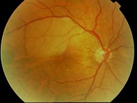img-Branch-Retinal-Artery-Occlusion