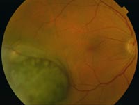 img-Choroidal-Melanoma