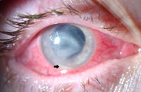 img-Corneal-Ulcer